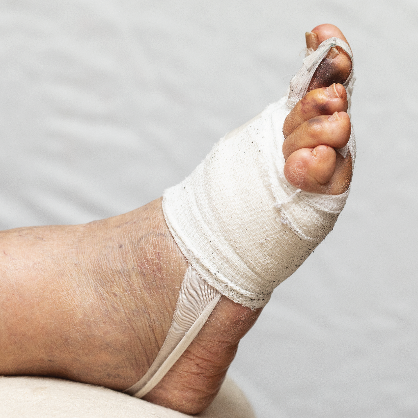 Foot wound requiring specialized care and monitoring.